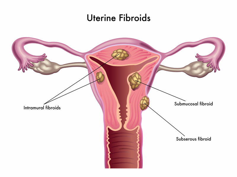 Uterus Fibroids & Estrogen Dominance Uterus Fibroids & Estrogen Dominance