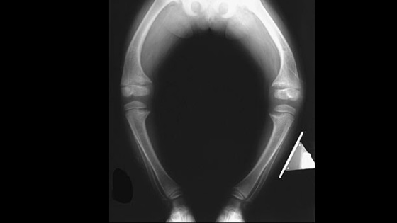 Rickets X-Ray Rickets X-Ray