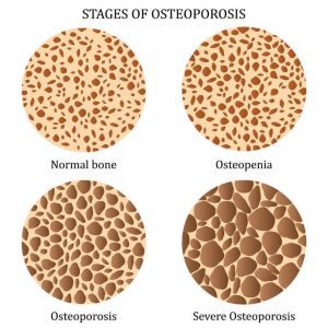 Stages of osteopenia to osteoporosis Stages of osteopenia to osteoporosis